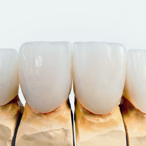Восстановление зуба керамическим виниром IPS e-emax Ceram